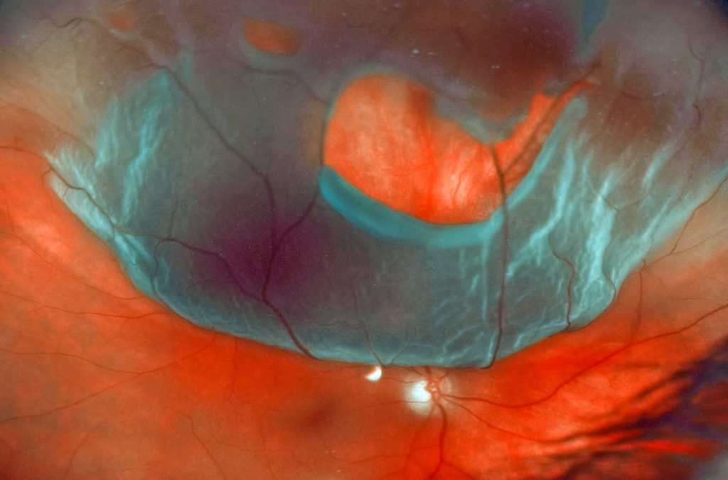 Understanding Retinal Detachment Repair Surgery