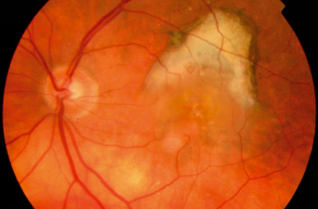 Treatment Options for Wet Age-Related Macular Degeneration?