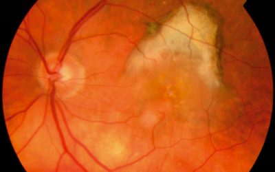 Treatment Options for Wet Age-Related Macular Degeneration?