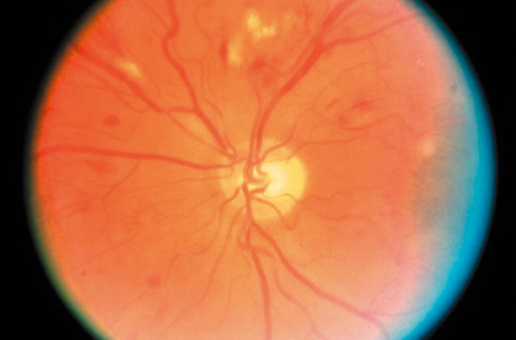 Is Hypertensive Retinopathy the Same as Diabetic Retinopathy?