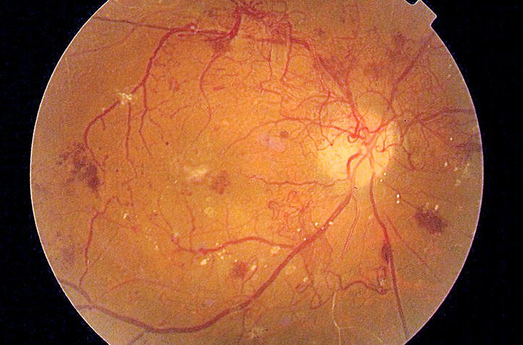 Understanding Proliferative and Nonproliferative Diabetic Retinopathy