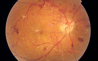 Understanding Proliferative and Nonproliferative Diabetic Retinopathy