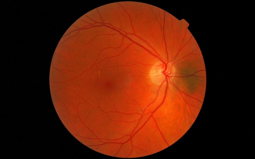 Can a Choroidal Nevus Affect Vision?