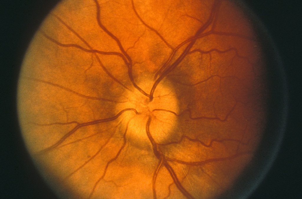 Are Swollen Optic Nerves Related to Obesity?