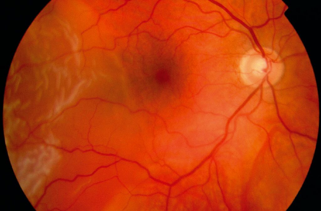 When Does a Macula-On Retinal Detachment Need Surgery