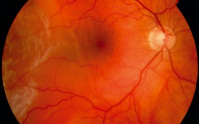 When Does a Macula-On Retinal Detachment Need Surgery